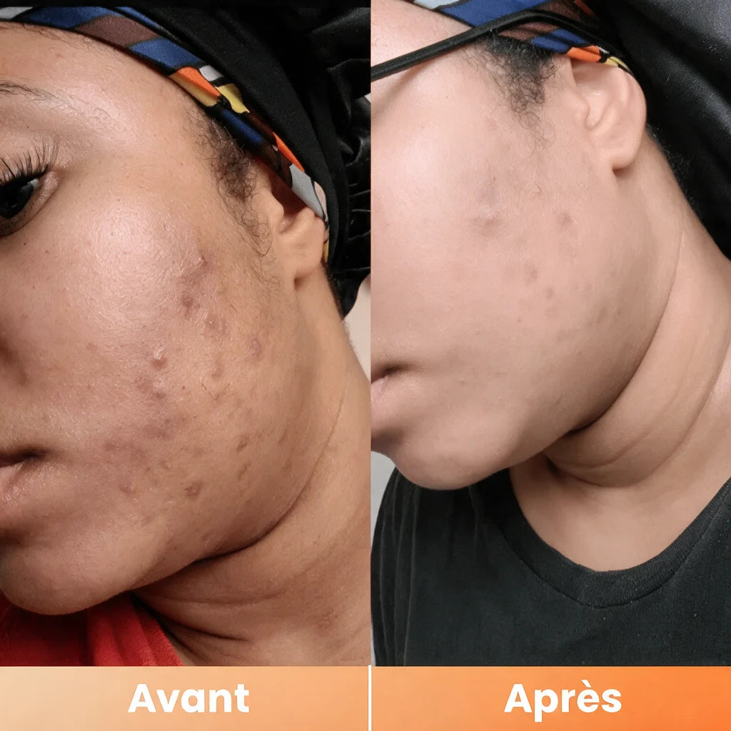 Peel Shot — Spray Exfoliant Kojic Acid + Curcuma