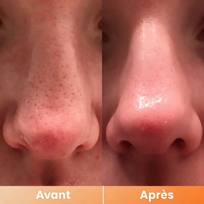 Peel Shot — Spray Exfoliant Kojic Acid + Curcuma