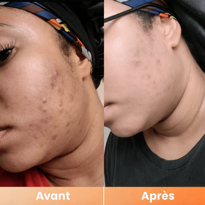 Peel Shot — Spray Exfoliant Kojic Acid + Curcuma